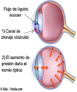 El glaucoma. Una breve explicación de sus efectos en la vida.